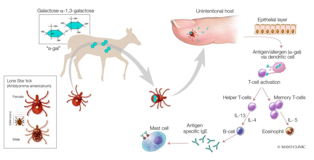 Mayo Clinic Minute: A tick to blame for the alpha-gal, meat allergy Mayo Clinic medical illustration showing how the lone star tick that has picked up a protein/antigen from a deer and transmitted it to a human. After the tick bite to the human, a standard IgE allergy sensitization reaction occurs.