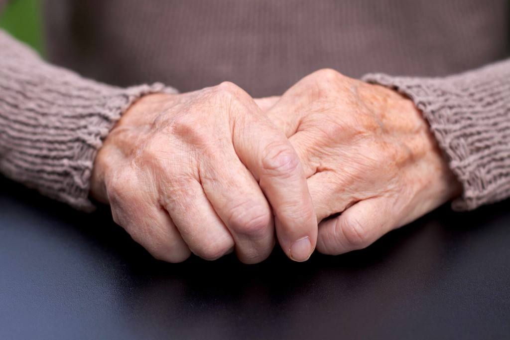 Consumer Health: Treating arthritis – Mayo Clinic News Network older adult hands showing arthritis