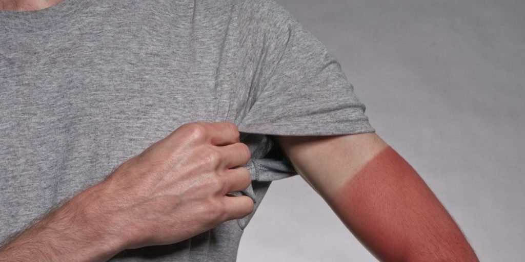 How to Get Rid of Sunburn Fast