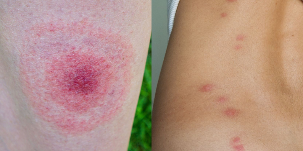 14 Pictures of Common Bug Bites and How to Identify Their Symptoms