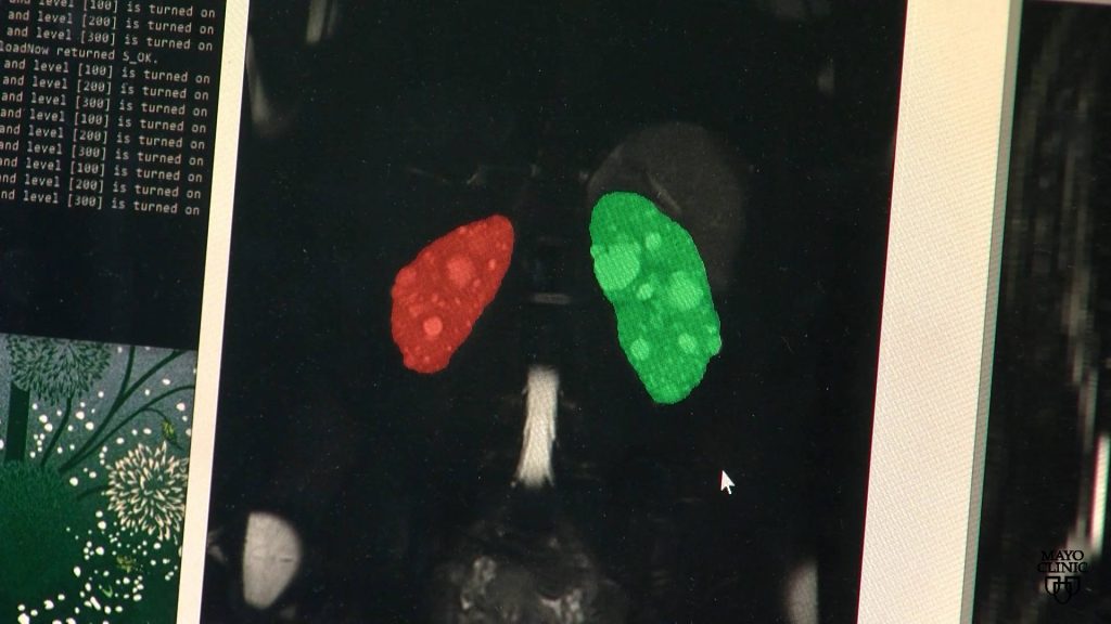 Science Saturday: Confronting polycystic kidney disease, a silent killer an image on a screen of two kidneys, one in red and the other in green, showing use of artificial intelligence in researching polycystic kidney disease