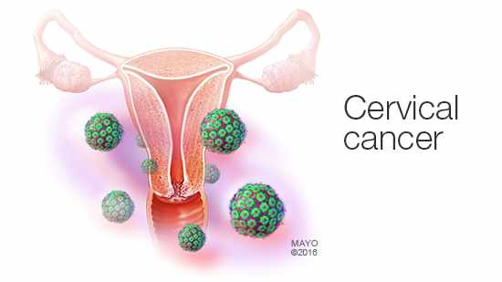 Mayo Clinic Minute: Cervical cancer screening medical illustration of female organs and cervical cancer
