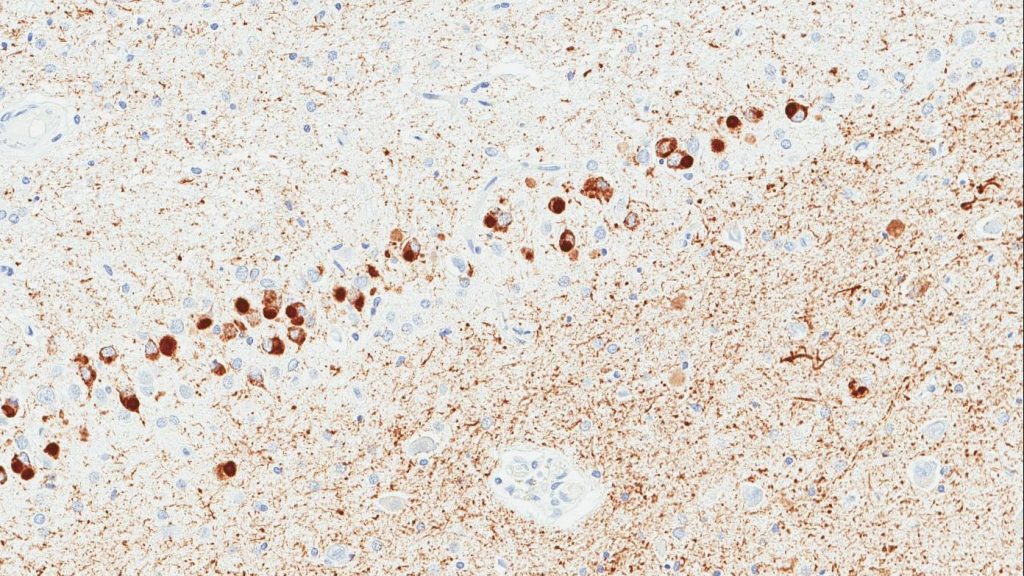 An image depicting Pick bodies in the brain, courtesy of Dennis Dickson, M.D.