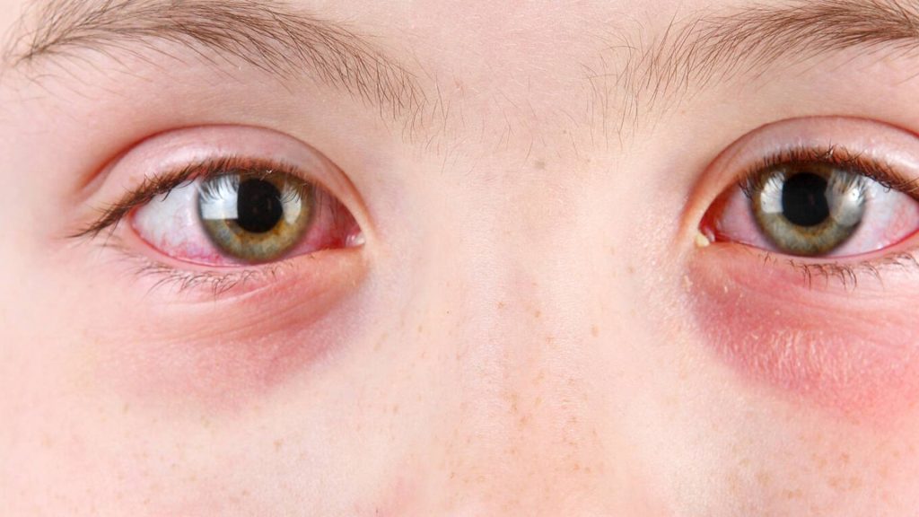 Mayo Clinic Minute: What is pink eye?