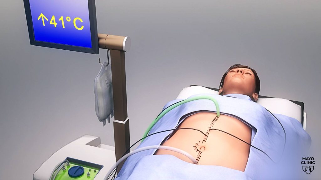 Mayo Clinic Minute: New chemotherapy approach for treating stomach cancer