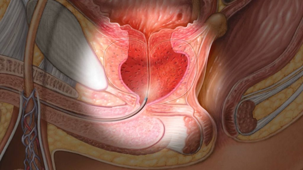 Mayo Clinic Minute: Can lifestyle changes help with enlarged prostate?