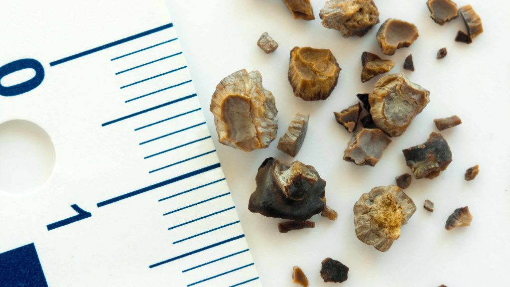 Mayo Clinic Minute: Misconceptions about how diet affects kidney stones
