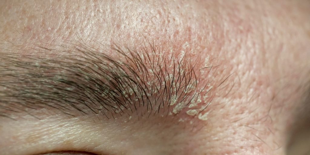 Yep, Eyebrow Dandruff Is a Thing. Here’s How to Get Rid of It