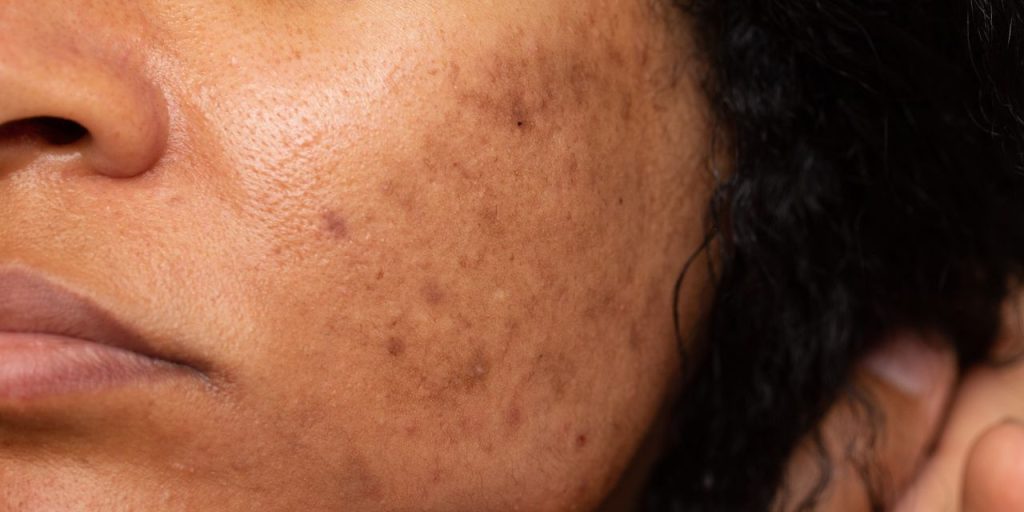 6 Skin-Care Mistakes That Are Making Your Dark Spots Worse